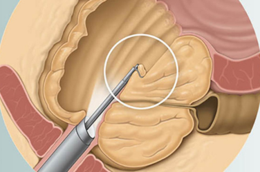 TURP Surgery & Holmium Laser Prostate Surgery